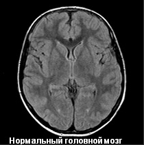 Головной мозг в норме на снимке МРТ